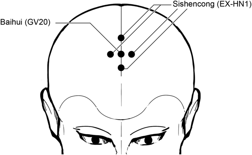 Figure1 Sishencong EX HN1 is a group of four points around GV20 Baihui each 1cun