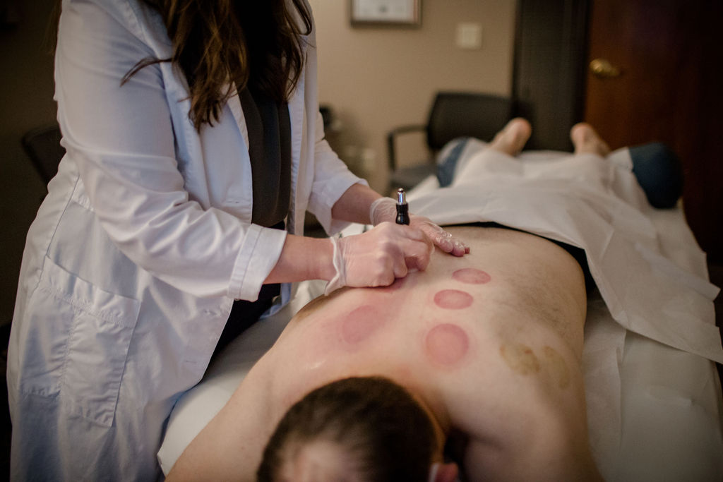 The Benefits of Cupping Therapy